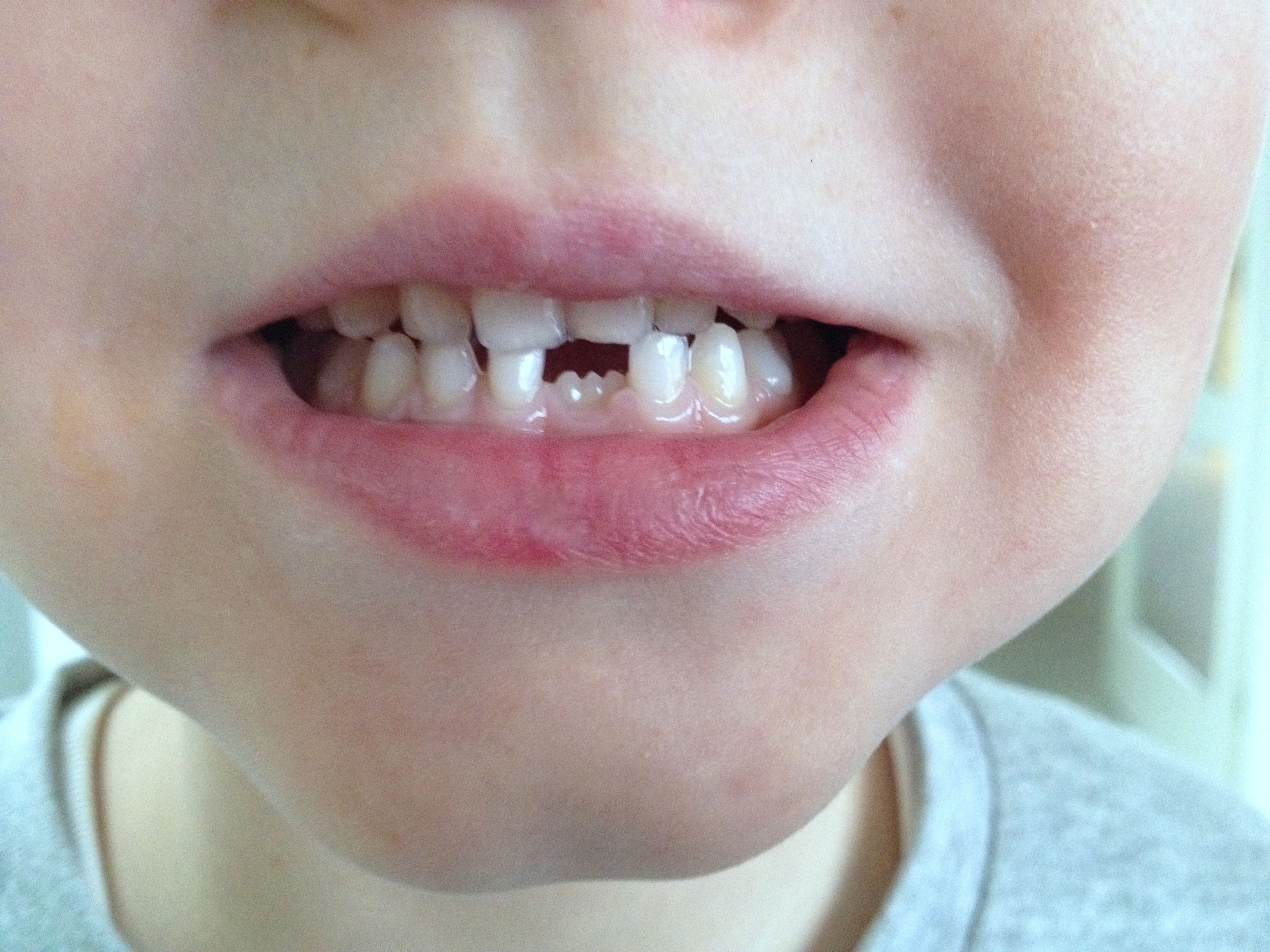 Tandsæt med ny fortand på vej