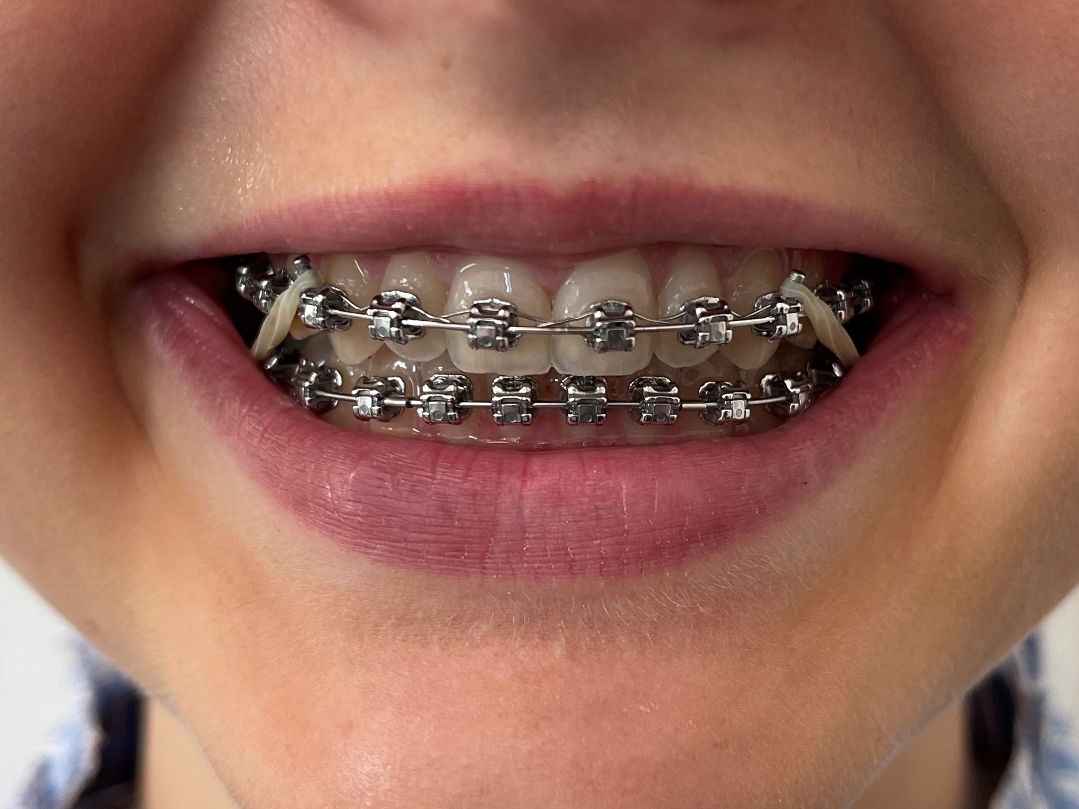 Tænder med fast bøjle på