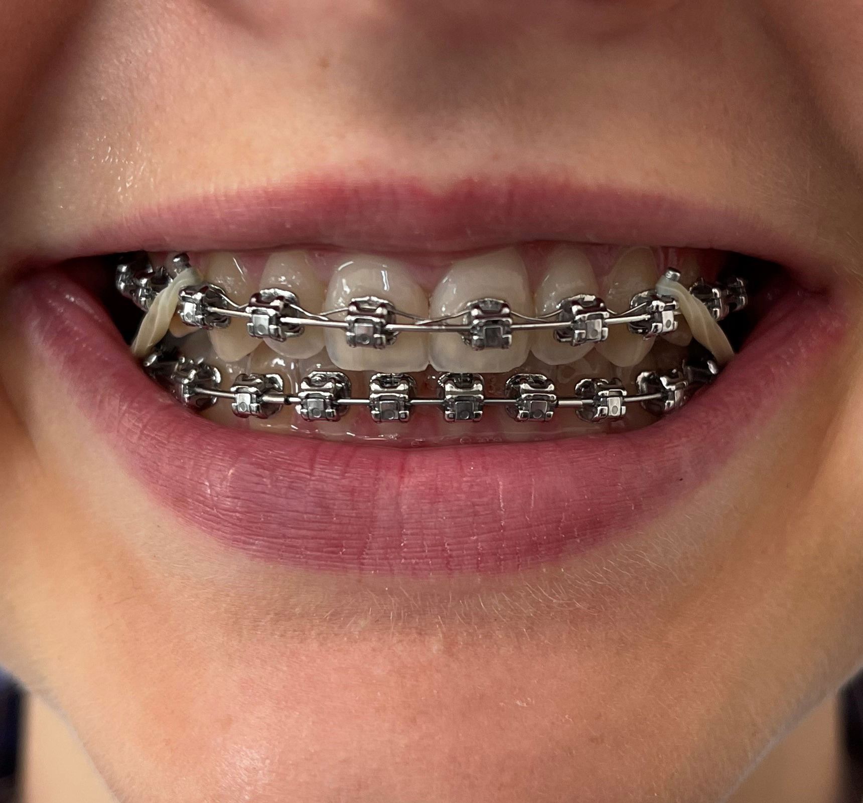 Tænder med fast bøjle på